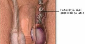 Почему одно яичко больше другого после операции