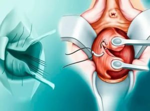 Как называется операция зашивания шейки матки