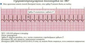 Можно ли делать кардиограмму во время месячных