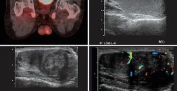 Узи органов мошонки с цдк что это такое