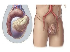 Что делать если у мужчины на одном яичке на одном из них опухоль