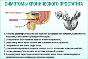 Признаки заболевания предстательной железы симптомы и лечение