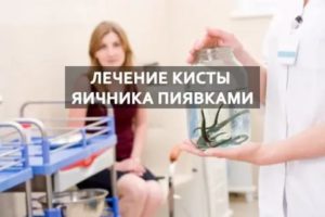 Как лечить пиявками кисту яичников