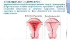 Что такое патология эндометрия при климаксе