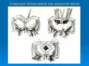 Кто делал операцию на двурогую матку