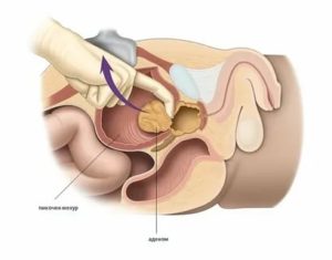 Осложнения после аденомэктомии простаты