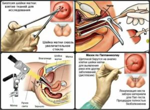 Может ли биопсия быть ошибочной при раке шейки матки