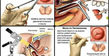 Может ли биопсия быть ошибочной при раке шейки матки