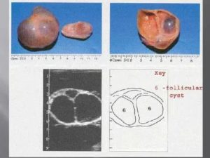Как вылечить у коровы кисту на яичнике