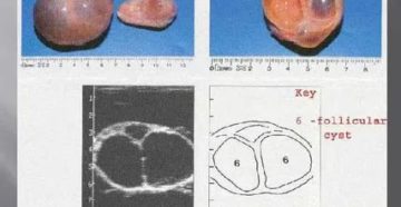 Как вылечить у коровы кисту на яичнике
