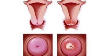 Почему после конизации шейки матки долго идут месячные что Почему после конизации шейки матки долго идут месячные что