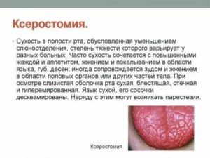 Сухость во рту при раке простаты