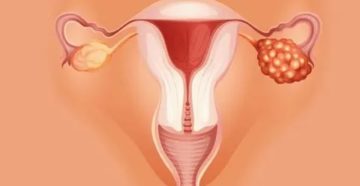 Почему киста болит после менструации Почему киста болит после менструации