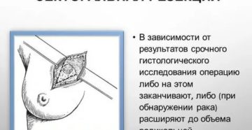 Секторальная резекция молочной железы при раке отзывы пациенток