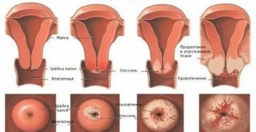 Что значит рак шейки матки с распадом
