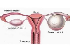 Почему болит правый яичник у женщин перед месячными