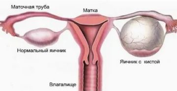 Почему болит правый яичник у женщин перед месячными Почему болит правый яичник у женщин перед месячными