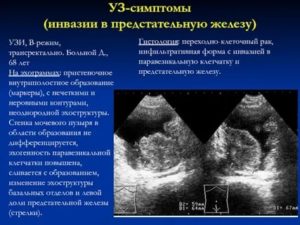 Предстательная железа эхоструктура неоднородная контур четкий