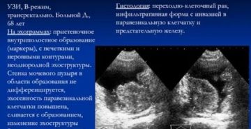 Предстательная железа эхоструктура неоднородная контур четкий