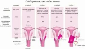 Что такое стадирование рака шейки матки