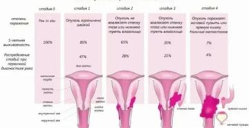 Что такое стадирование рака шейки матки