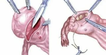 Что такое резекция яичника на операции