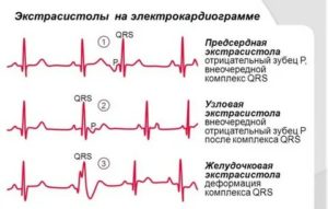 Могут ли быть в месячные экстрасистолы