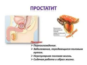 Заболевание предстательной железы у мужчин причины заболевания
