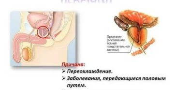 Заболевание предстательной железы у мужчин причины заболевания