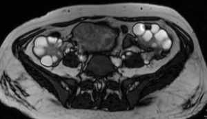 Что показывает мрт яичников и матки