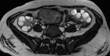 Что показывает мрт яичников и матки