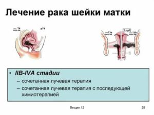 Как выглядит шейка матки после лучевой терапии