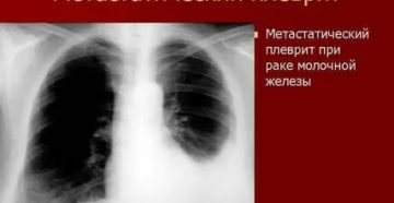 Метастатический плеврит при раке молочной железы прогноз