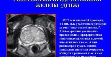 Мрт-признаки гиперплазии предстательной железы
