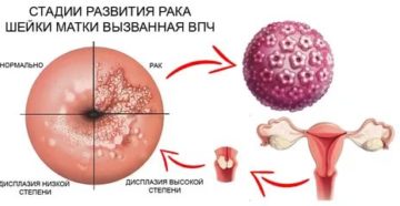 Кондиломы на шейке матки это рак