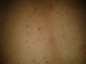 Когда появляются красные пятна на теле при вич
