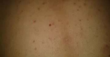 Когда появляются красные пятна на теле при вич