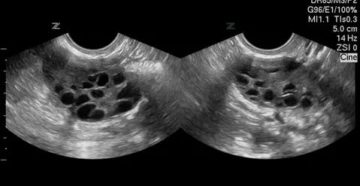 Что такое мультикистоз яичников и как его лечить