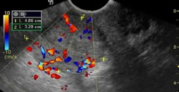 Можно ли по узи определить рак шейки матки на ранней стадии