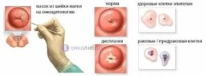 Подготовка к онкоцитологии шейки матки