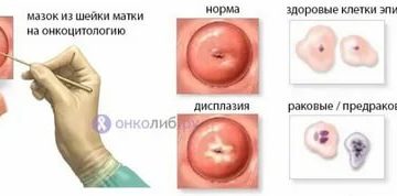 Подготовка к онкоцитологии шейки матки