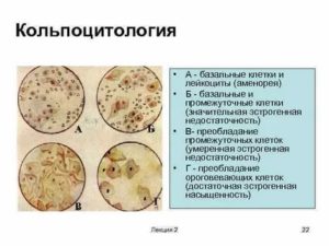 Что такое кольпоцитология шейки матки