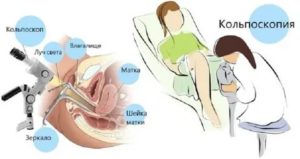 Когда делают кольпоскопию шейки матки до месячных или после месячных