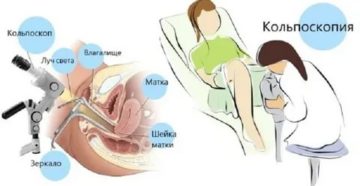 Когда делают кольпоскопию шейки матки до месячных или после месячных