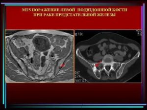 Рак подвздошной кости из-за рака простаты