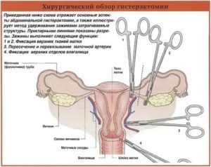 Как морально подготовиться к операции по удалению матки и придатков