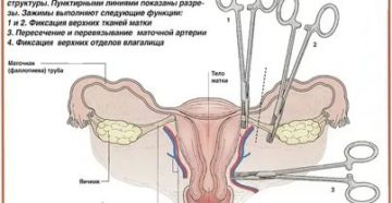 Как морально подготовиться к операции по удалению матки и придатков