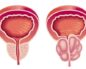 Кровотечения при аденоме простаты как остановить