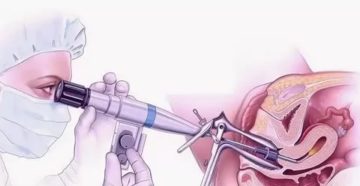 Что такое гистероскопия в гинекологии и как она проводится