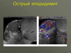 Что такое острый левосторонний эпидидимит
